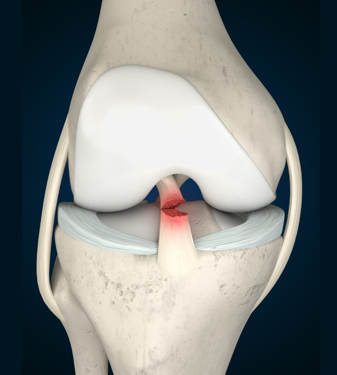 Arthroscopic ACL surgery in Delhi by knee specialist