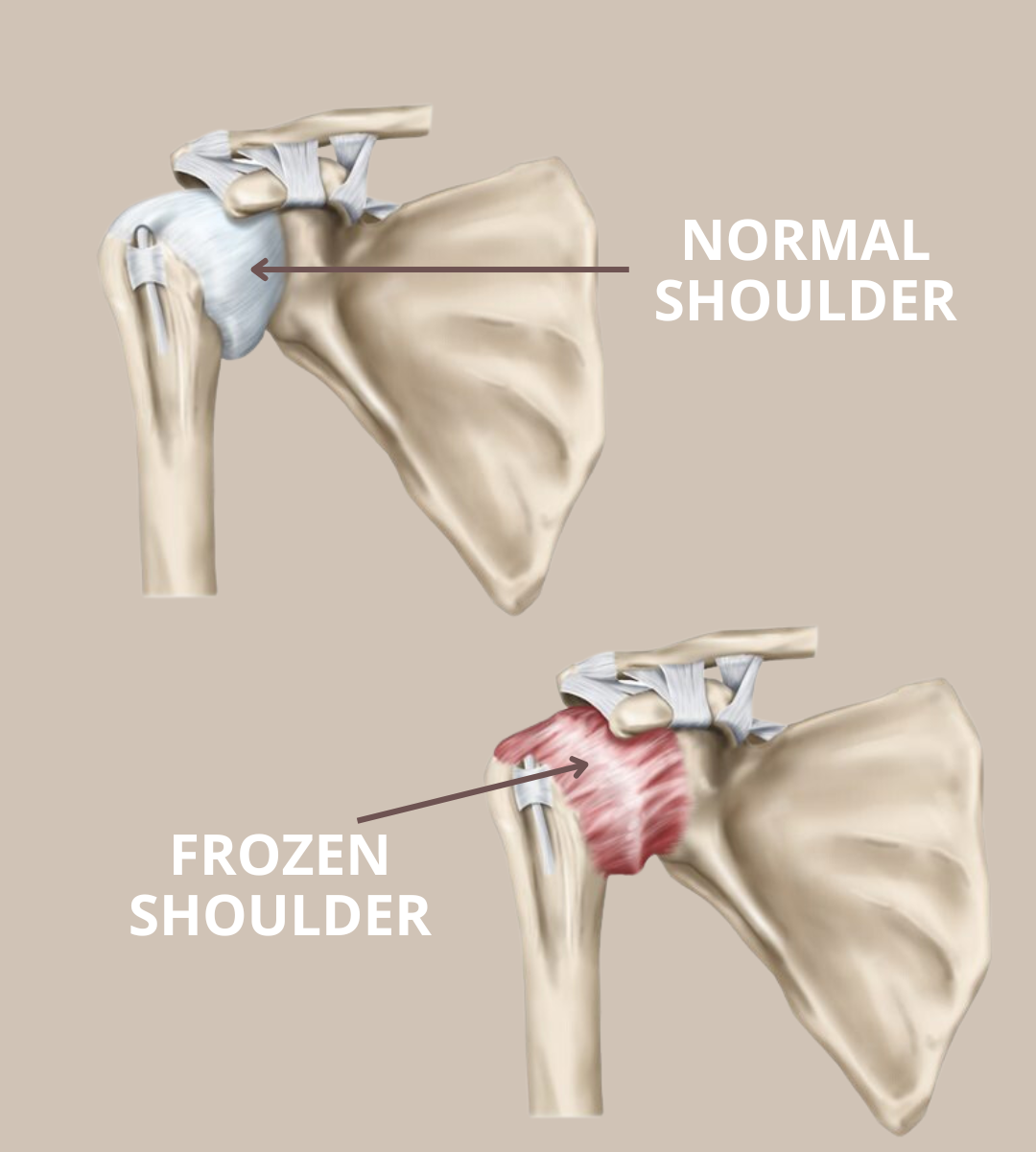 Arthroscopy for frozen shoulder treatment