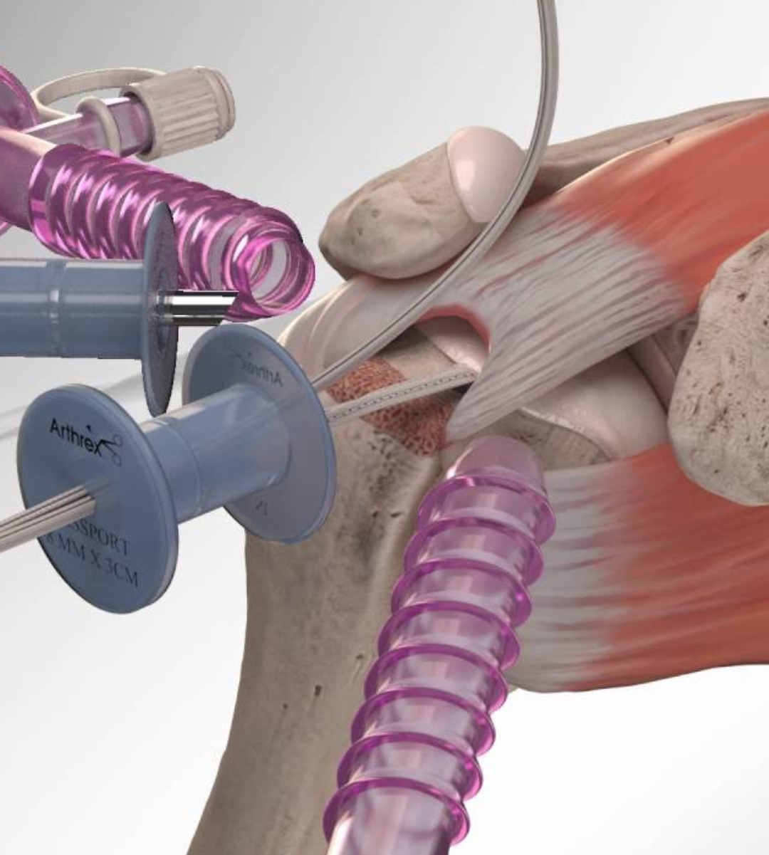 Arthroscopic rotator cuff surgery to repair shoulder tendons