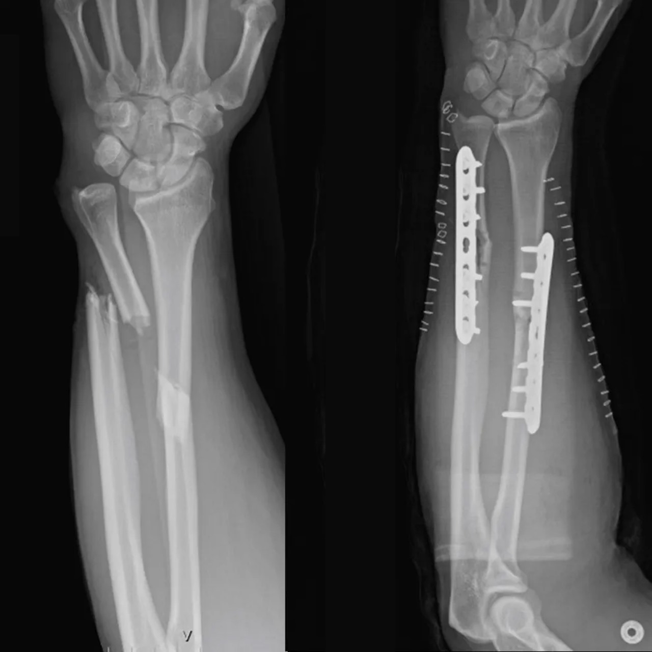 fracture recovery treatment delhi
