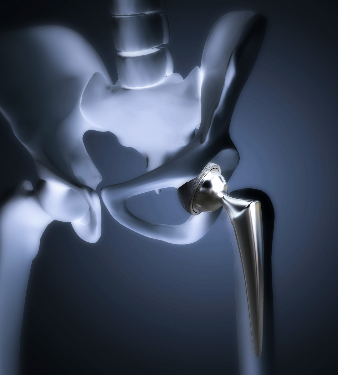 Hip replacement surgery by joint replacement surgeon in Delhi