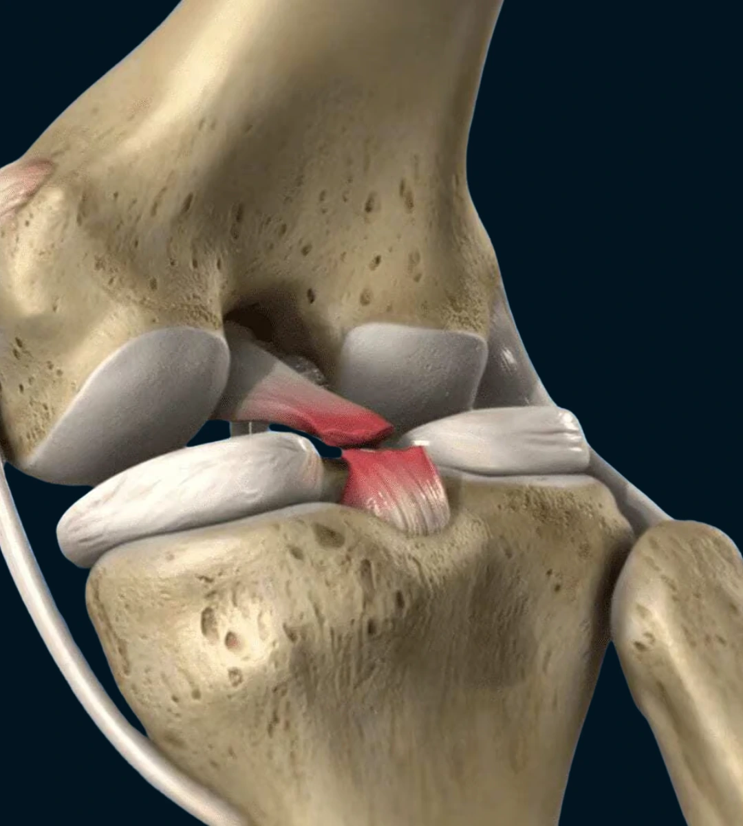 PCL surgery in Delhi for posterior cruciate ligament injury