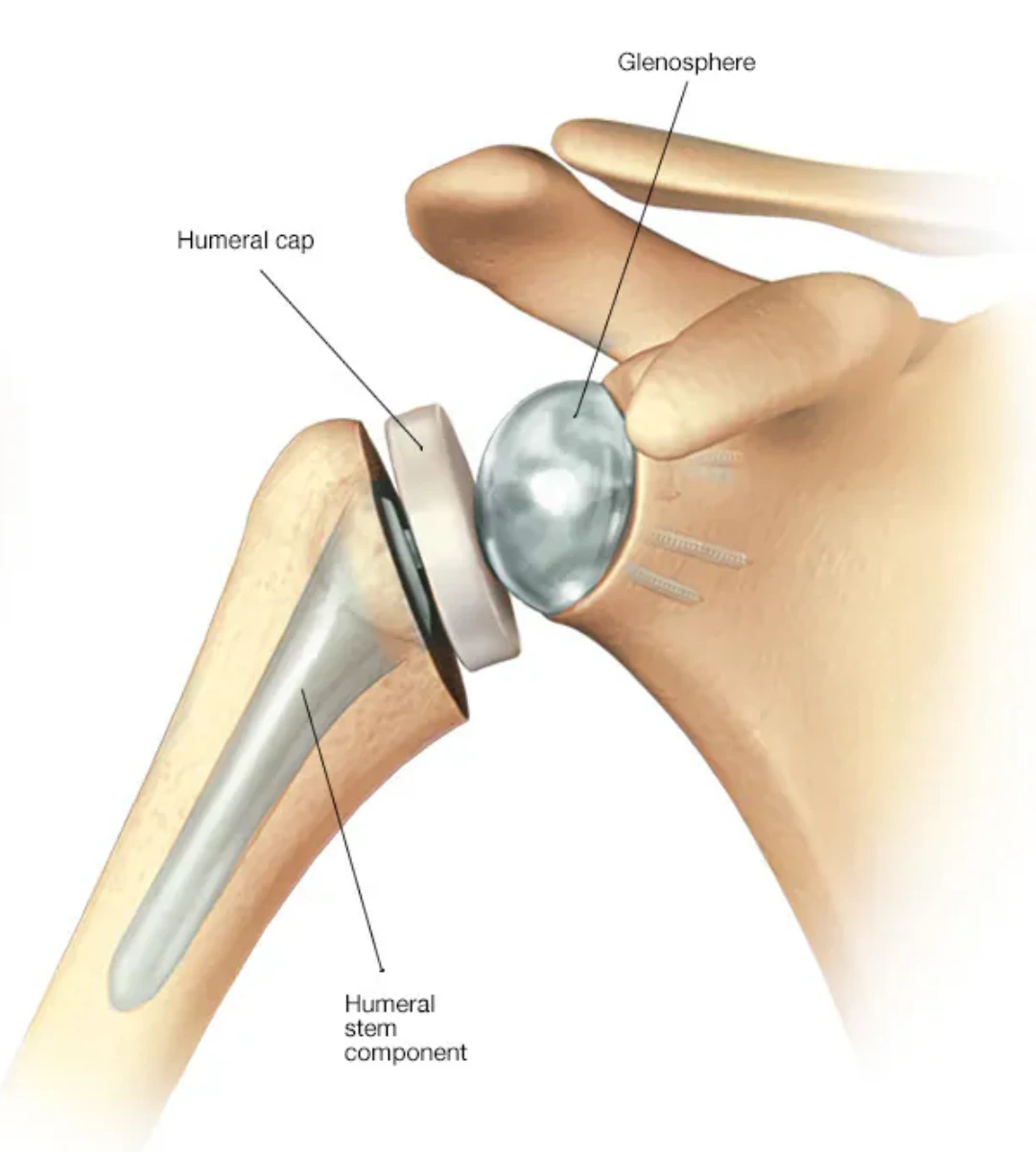 Shoulder replacement surgery by joint replacement surgeon in Delhi