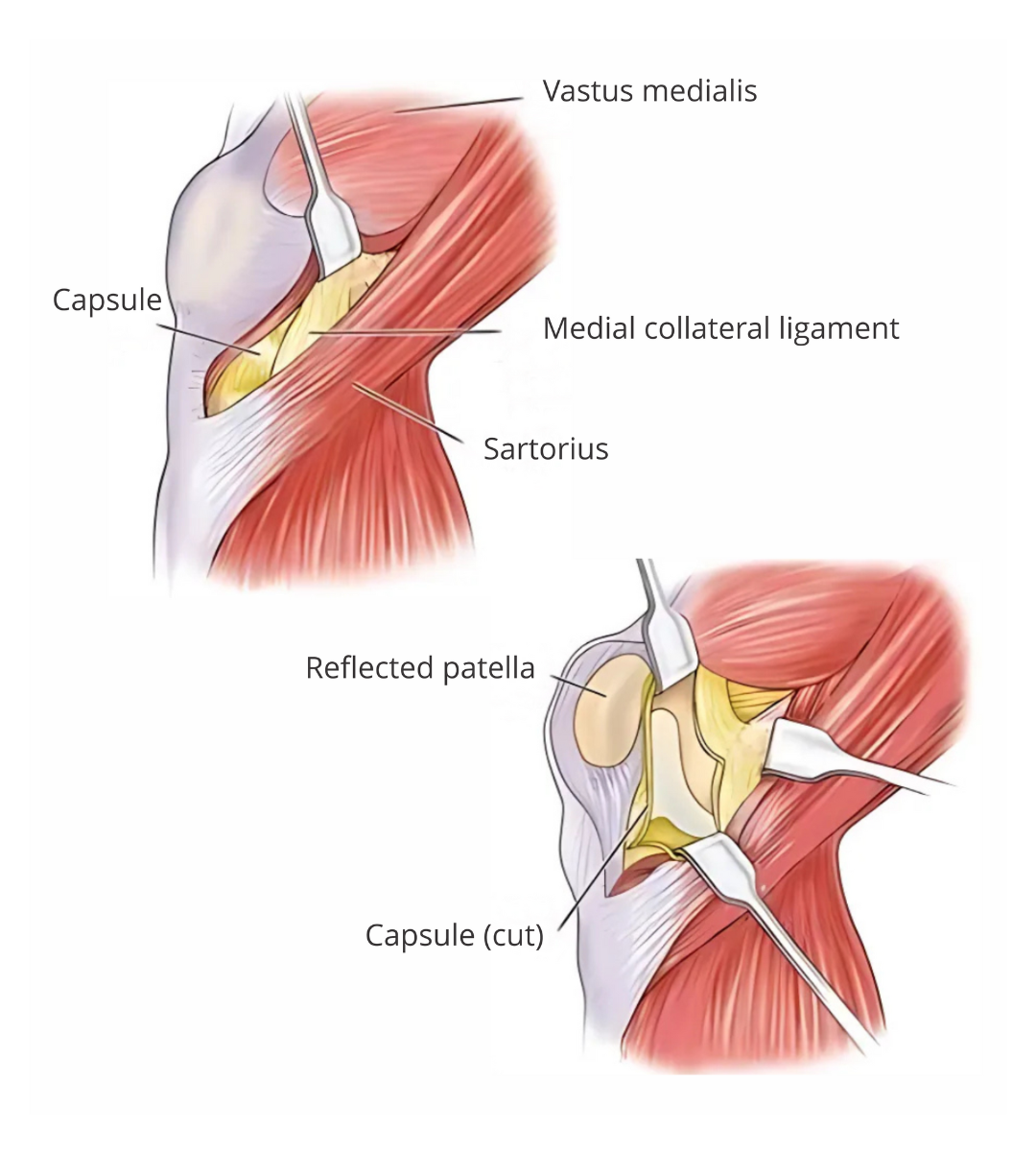 MISCR knee replacement surgery by joint replacement surgeon in Delhi